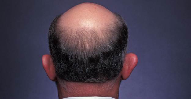 Erkeklerde Saç Dökülmesi Nedenleri