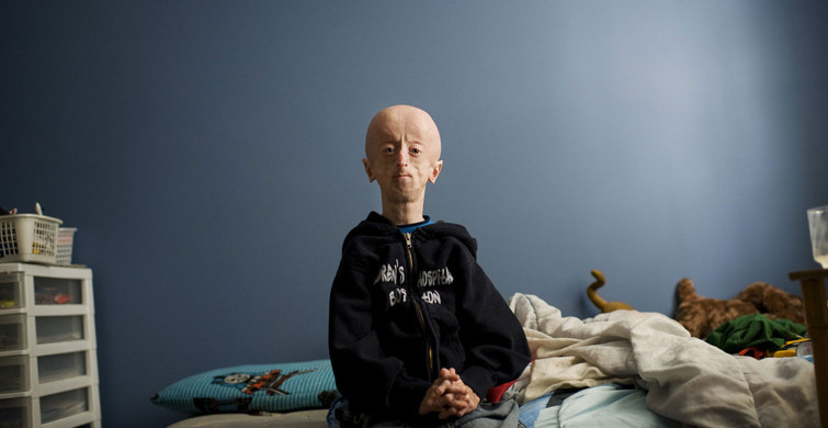 Erken Yaşlanma Hastalığı Progeria Nedir, Belirtileri Neler?