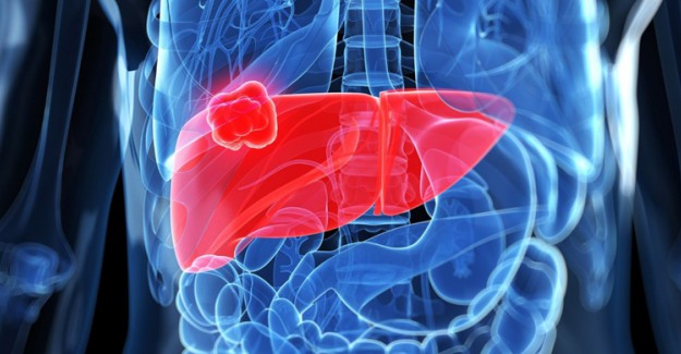 Karaciğer Kanseri Nasıl Oluşur? Belirtileri Nelerdir?