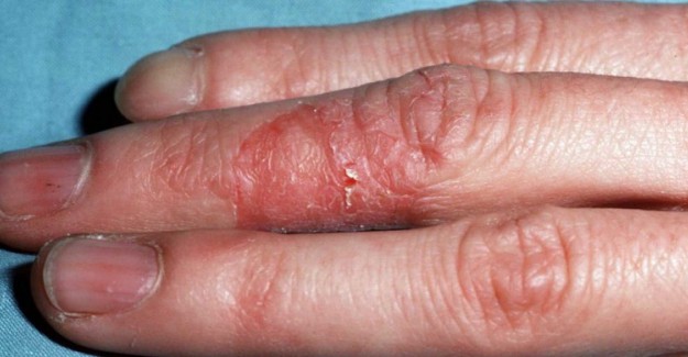 Kontakt Dermatit Nedir? Belirtileri Nelerdir?