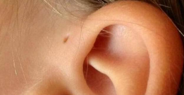 Kulakların Üzerindeki Minik Delikler: Preoriküler