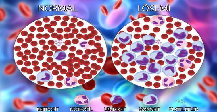 Lösemi nedir tedavisi nasıl olur? Löseminin belirtileri nelerdir? Kaç yaşlarında olur? Lösemi öldürür mü?