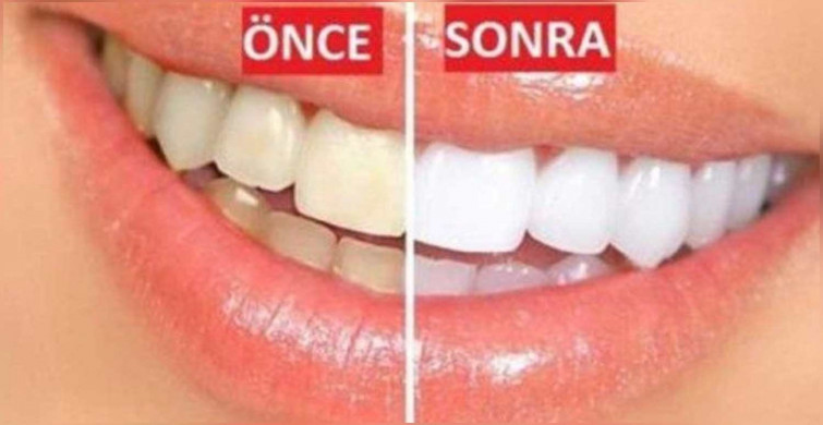 Sarı dişler nasıl beyazlatılır? Ev yapımı doğal ve bitkisel karışımlar ile sarı dişleri beyazlatma yöntemleri