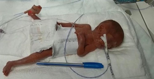 Türkiye'de Bir İlk, 285 Gram Doğan Elçin Bebek Hayata Tutundu"