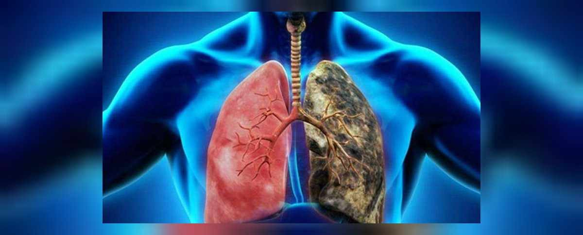 Akciğer kanseri belirtileri