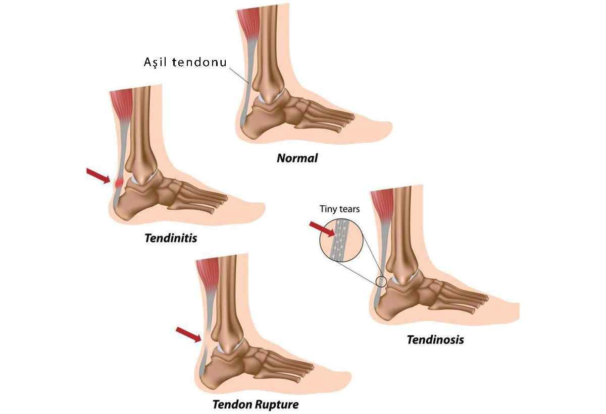 aşil tendonu