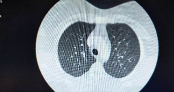 Koronavirüse Yakalanan Hastaların Ciğerlerindeki Görüntü Dehşete Düşürdü	