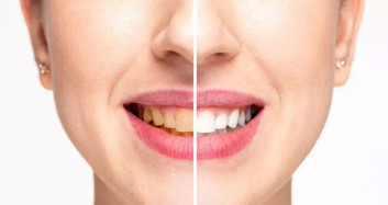 Diş Hekimleri Bunu Öğrenmeni İstemiyor! Diş Hekimine Gitmeden 3 Dakikada Tartarı Ortadan Kaldırın!