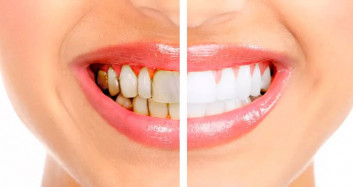 Dişlerde Oluşan Tartar Diş Hekimine Gitmeden Nasıl Ortadan Kaldırılır?